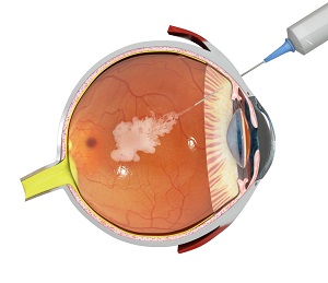 Intravitreal Injection for Macular Edema