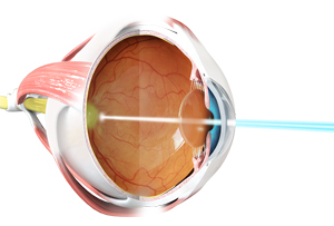 Retinal Laser Therapy