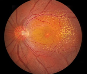 Age-Related Macular Degeneration