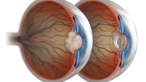 Cataract Surgery in People with Retinal Diseases