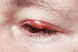 chalazion