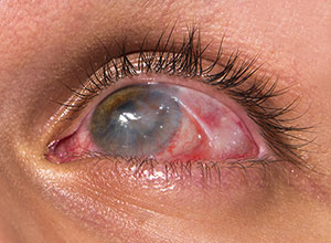 Conjunctival & Corneal Tear