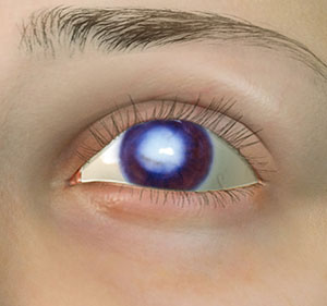 Corneal Opacity