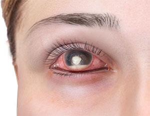 Corneal Ulcer