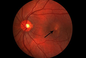 Cystoid Macular edema