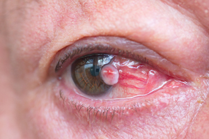 Diseases of Cornea