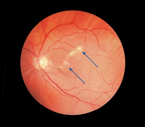 Epiretinal Membrane