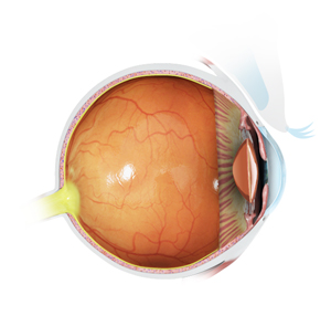 Acute/ Chronic/Recurrent Iridocyclitis