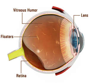 Vision Disorders