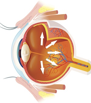 glaucoma