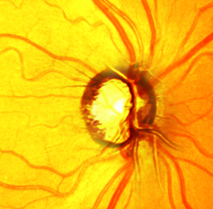 Heidelberg Retinal Tomography