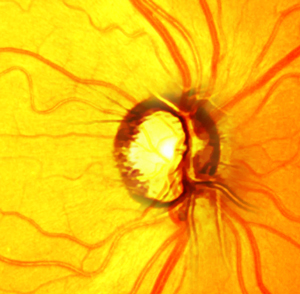 Heidelberg Retinal Tomography