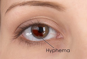 hyphema