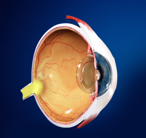 Intraocular Lens