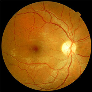 Macular Edema