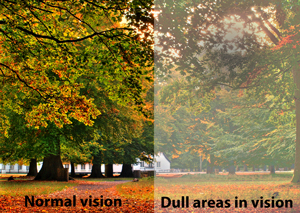 Shadows or Dull Areas in the Vision