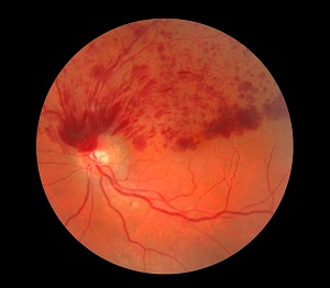 Ocular ischemic syndrome