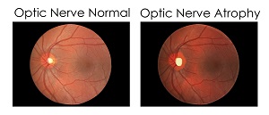 optic-nerve-atrophy
