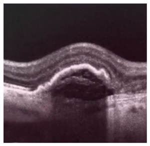 Optical Coherence Tomography