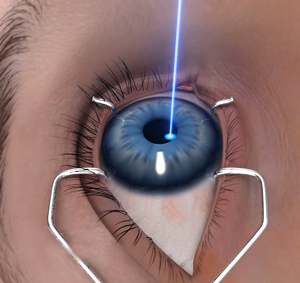 Photorefractive Keratectomy