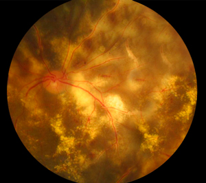 Posterior Uveitis