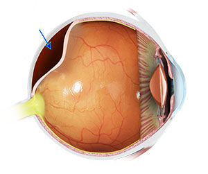 Posterior Vitreous Detachment