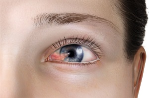 pterygium