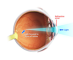 Refractive Errors