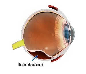 Treatment for Retinal Detachment
