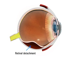 Retinal Tear vs. Retinal Detachment - Monterey, CA - Salinas