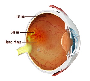 Retinal Vein Occlusion