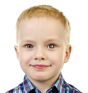 Retinoblastoma