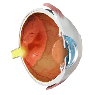 Retinopathy of Prematurity