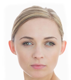 strabismus