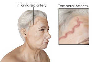 temporal-arteriris