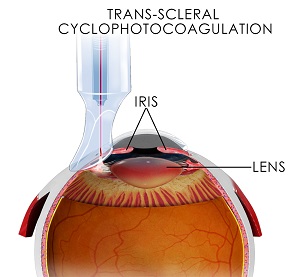 trans-scleral-cyclophotocoagulation