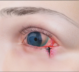 Treatment of Orbital or Ocular Tumor