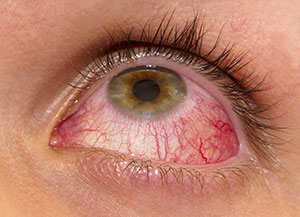 Uveitis & Ocular Inflammation