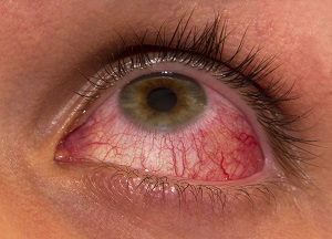 Uveitis and Ocular Inflammation