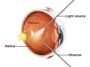 Vitrectomy for Epiretinal Membrane