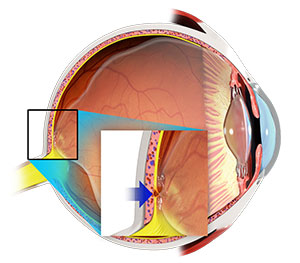 Vitreomacular Traction Syndrome