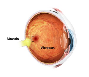 Vitreomacular Traction Syndrome