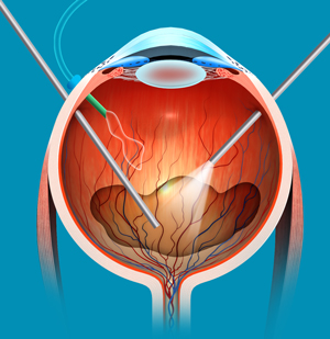 Vitreoretinal Surgery