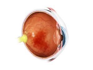 Vitrectomy for the Treatment of Vitreous Hemorrhage