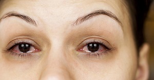 Ephiphora: What Causes Teary Eyes?